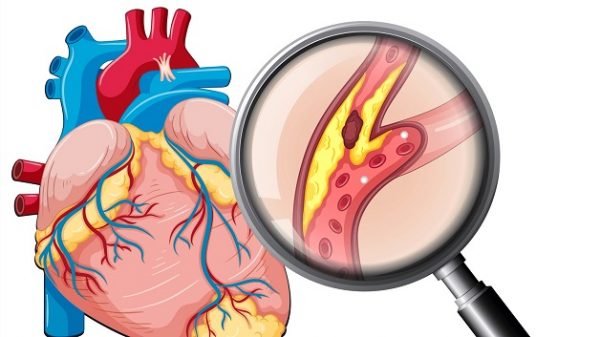 Bệnh động mạch vành cũng có thể là yếu tố gây suy tim.