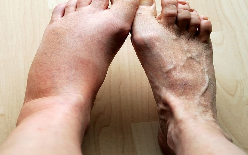 Phù chân là một trong các dấu hiệu suy tim ở người già.