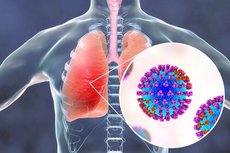 Viêm phổi ở người già thường do các loại virus, tụ cầu,...