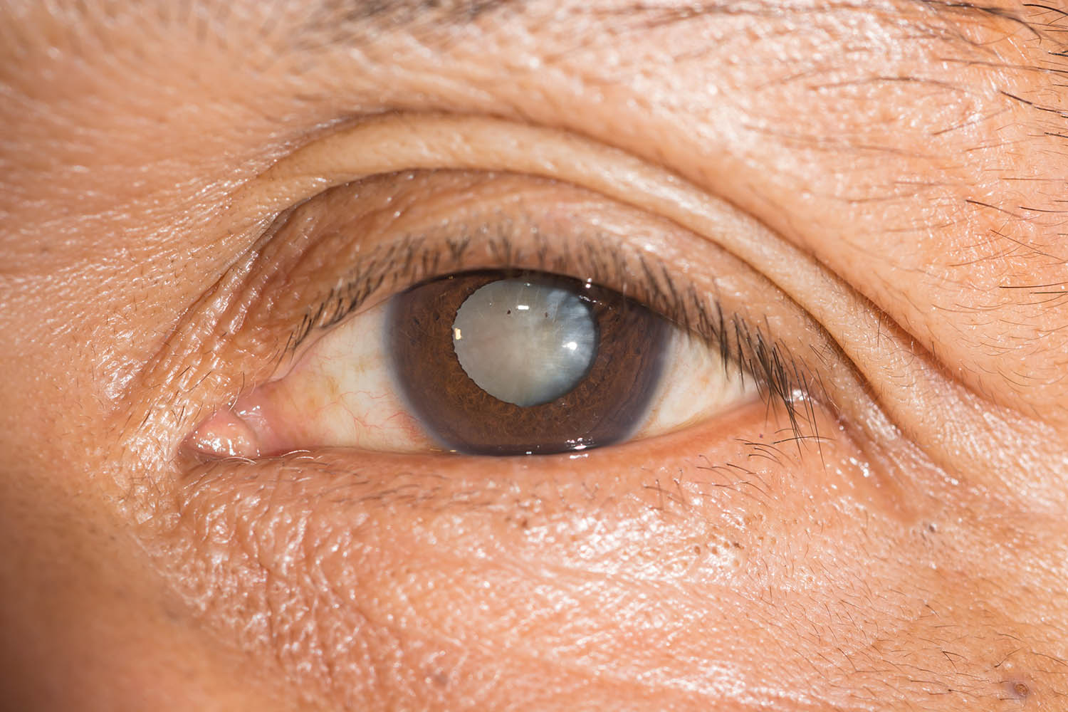 Đục thủy tinh thể là bệnh về mắt ở người cao tuổi thường gặp.