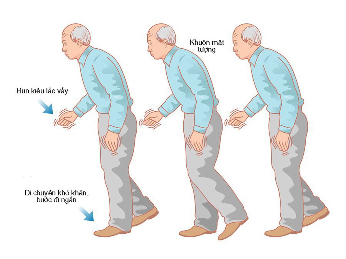 Bệnh Parkinson ở người già khiến vận động khó khăn.