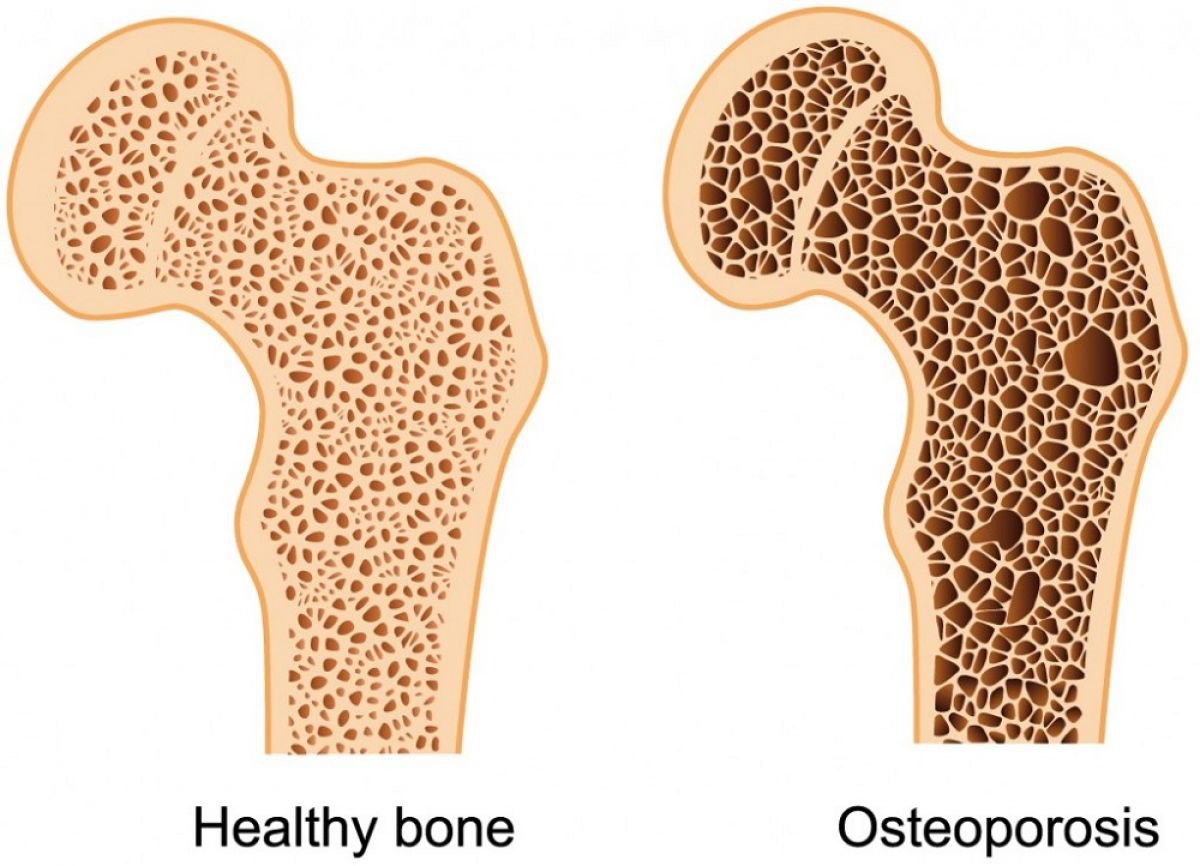 Bệnh loãng xương ở người già do các xương bị thưa, xốp và giảm khối lượng.