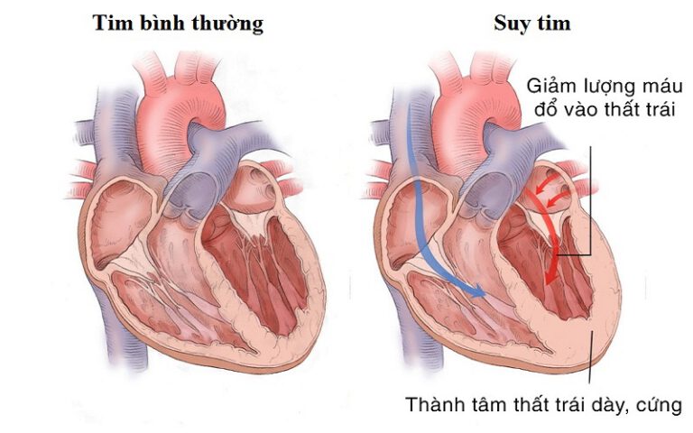 Sự khác biệt của trái tim bình thường và trái tim bị suy